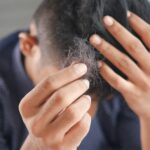 hair loss problem