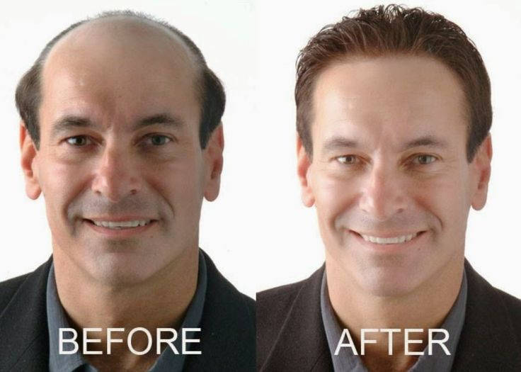 hair loss before and after treatment 